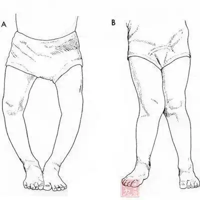 内八字脚内八字脚走路视频