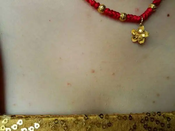 胸上长些小颗粒,是怎么回事?