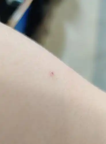 这是疫苗后正常的反应吗针眼位置很痒