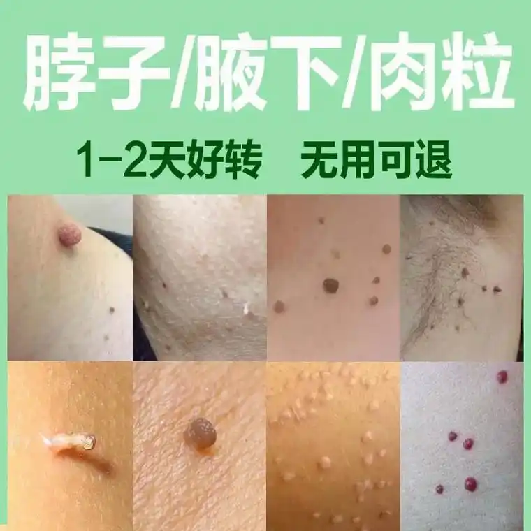 脖子上的小肉粒我有办法对付你用它
