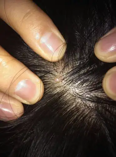 脑袋上有一个肉瘤 求指教