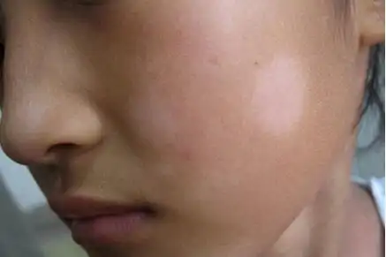 儿童白色糠疹白斑多久能消如何判断