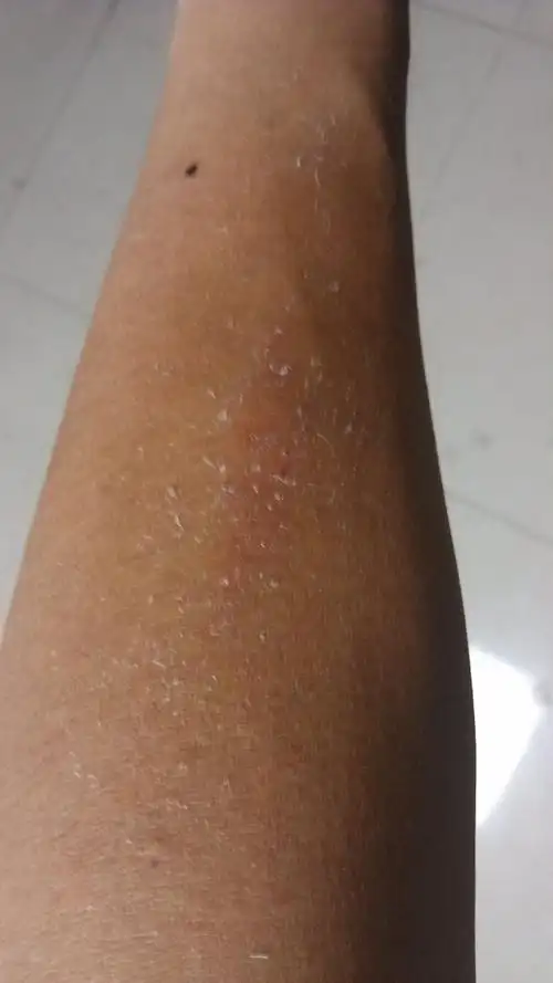 最近手臂上蜕皮,只有左手臂但是右手臂正常.如图,有人知道什么原因吗?