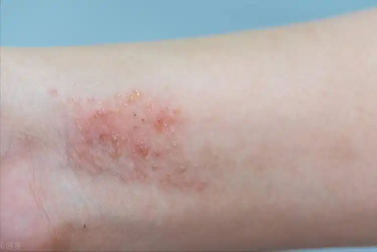 对称性湿疹图片(为什么湿疹反反复复) - 赤虎壹号
