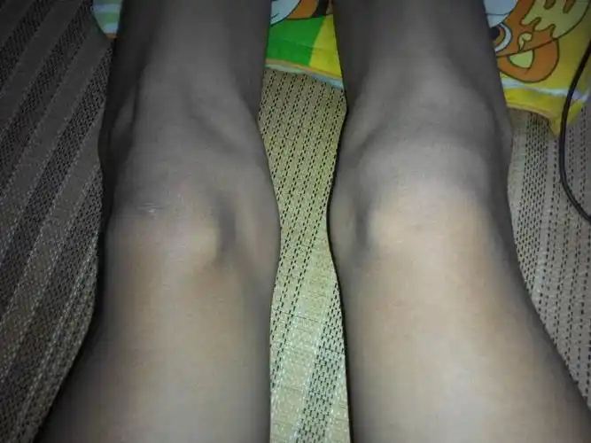 腿上关节外侧有块圆骨凸出