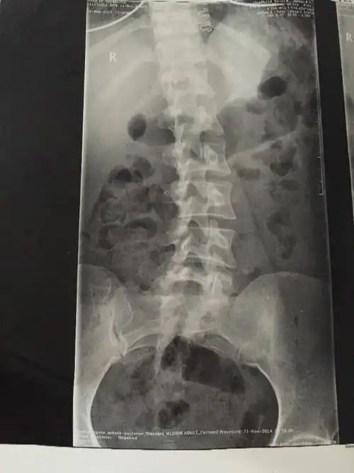 请问这是脊椎向左弯还是向右弯,,这个是腰椎放射x线.