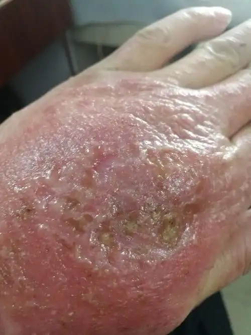 可怕的湿疹严重困扰了我一年多,终于有些好转,见人可以大胆伸出手来了