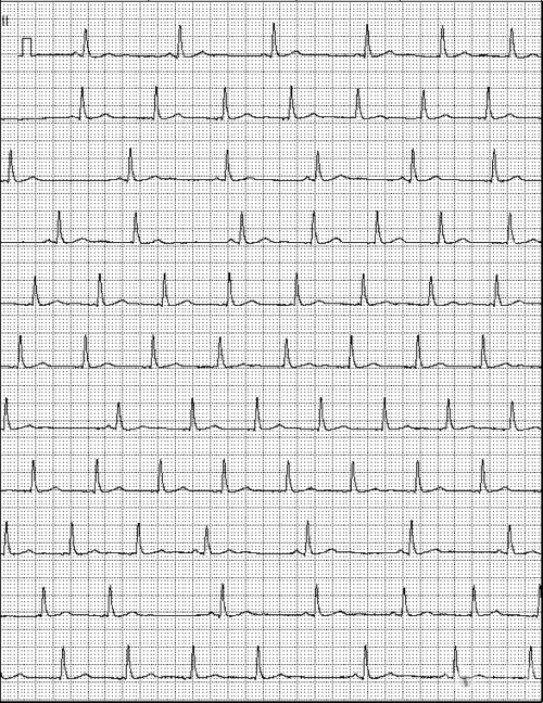 请问老师这幅图的p波时隐时现,是什么情况 - 心电图脑电图专业讨论版