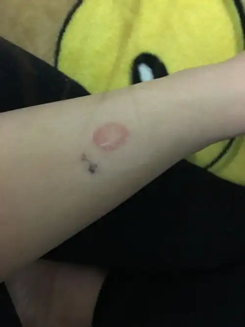 这个是什么藓,谁能回答我,是狗或猫传染我的么,还是圆藓