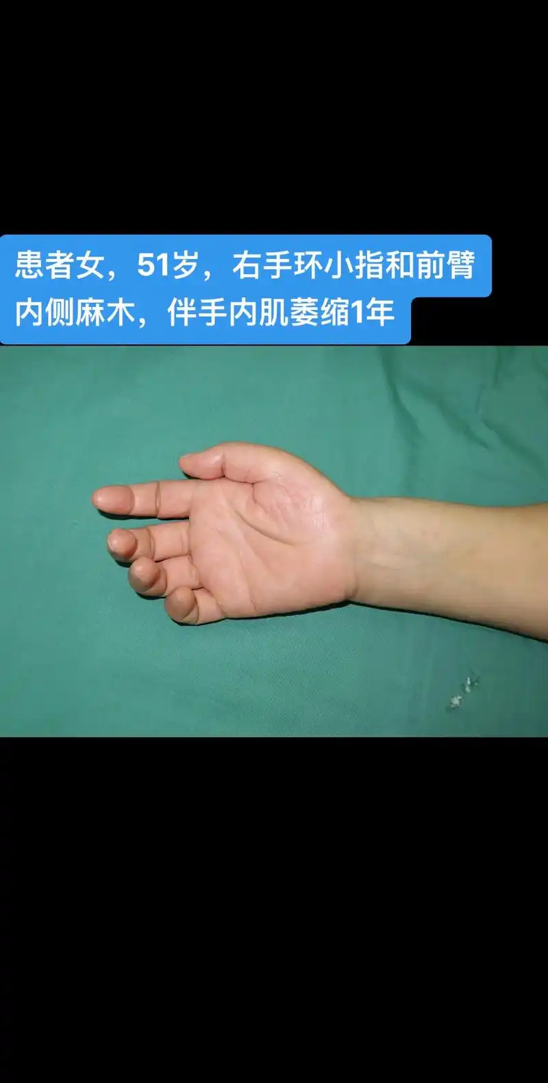 胸廓出口综合征,还是要早点看!#手麻 #肌萎缩 #臂丛神经损 - 抖音