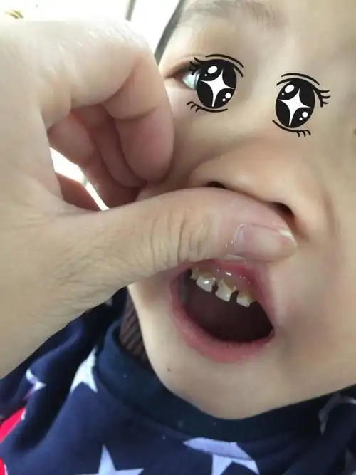有谁知道小孩的牙齿为什么会是这样的