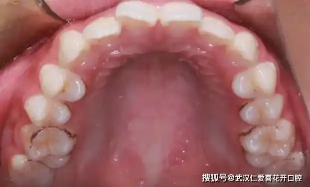 武汉仁爱喜花开口腔 10-07 14:26 订阅 患者·基本情况 吴xx 女,17岁