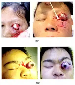 单纯性眼球脱臼二例