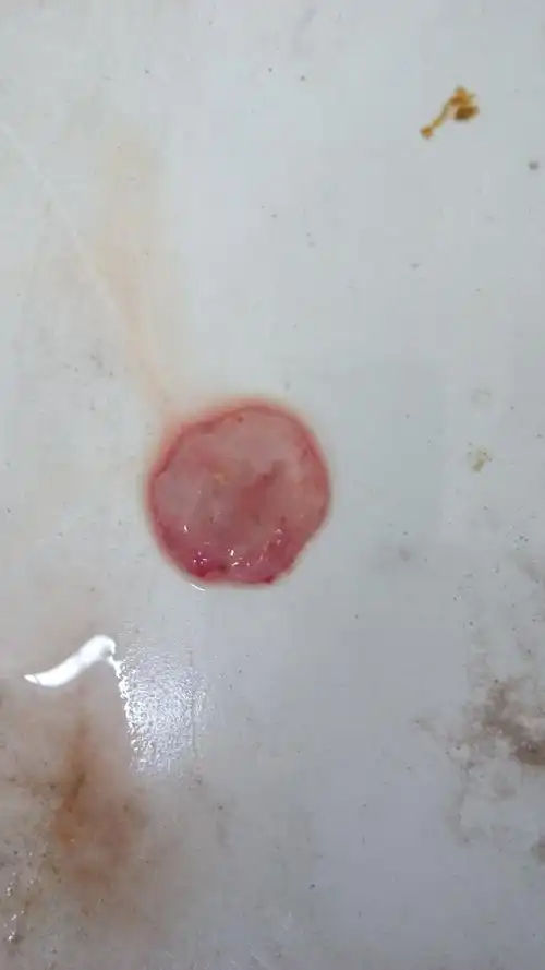 药流排出的物体,大家看下是孕囊吗请问药流一个小时后排出这个是胎囊