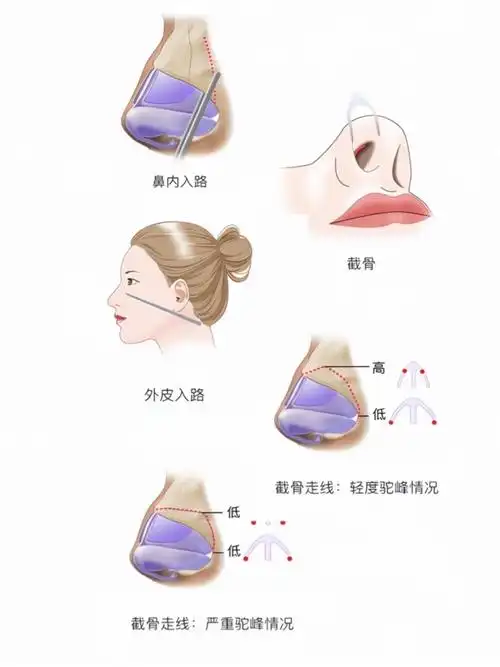 鼻骨发育不良会导致多种美观问题,如塌鼻梁,短鼻子,露鼻孔等.