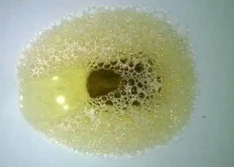 尿液中泡沫增多是怎么回事泡沫尿是不是肾不好