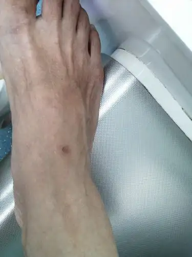 我的右脚背怎么了?