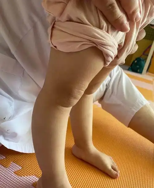 导致的骨盆前倾和下肢膝过伸.尤其在站立时较明显.(见图)在文章的