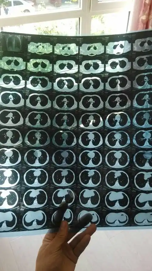 出结果,我是2012年年末在安徽黄山入职体检发现右上肺浸润性肺结核