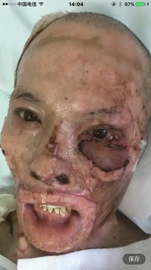 严重烧伤后左下睑外翻畸形修复 - 好大夫在线