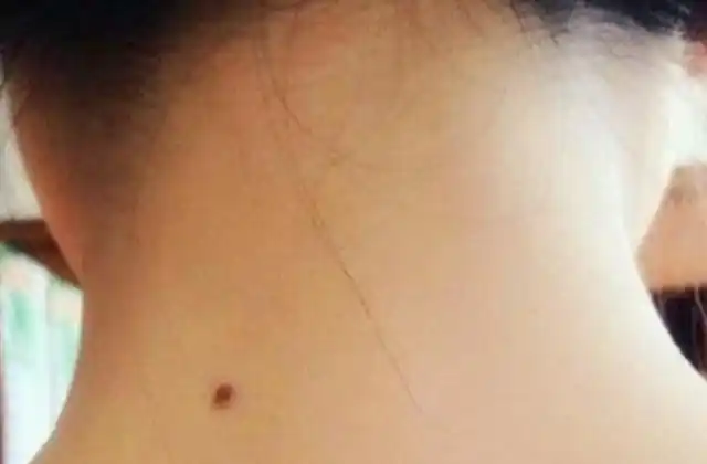 脖子后边的一颗痣是好是坏如果你也有建议看看