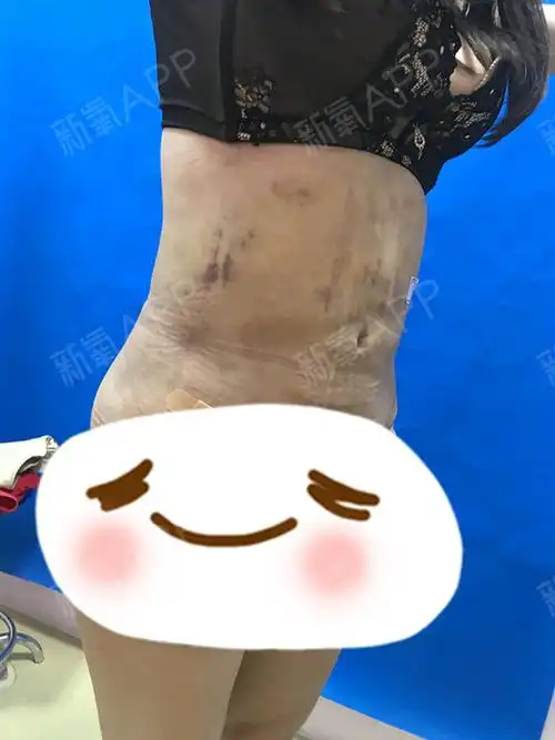 数11粉丝数7点赞与收藏227关 注私 信相关日记大腿吸脂可以让腿部变直