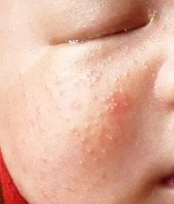 婴儿脸是痱子还是湿诊?