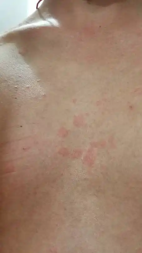 请问这是汗斑么?有什么好的治疗方案?