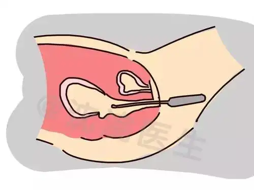 口服?还是阴塞?不同黄体酮给药方式都有哪些区别?