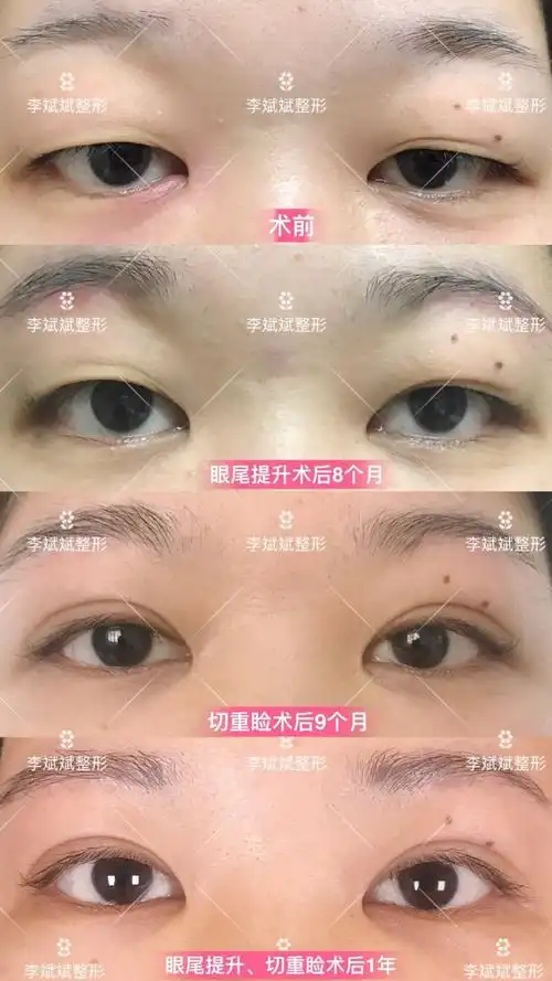 李斌斌手术实例——外眼角提升术详解及案例:外眼角提升适合哪些人