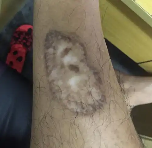 这是我小腿,这个疤是烫伤留下的.觉得很不好看,短裤也不好穿了.