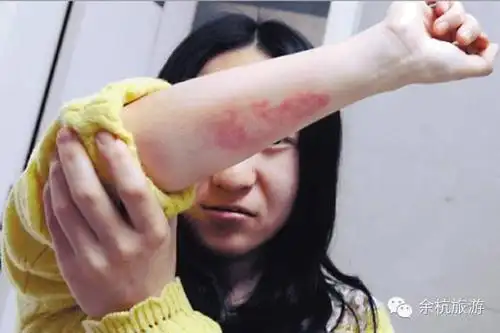 23岁的余杭小姑娘大冬天的"被烫伤",太可怕了!
