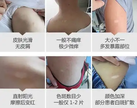白斑答疑身上长白斑是啥病