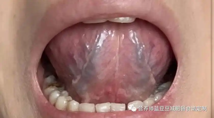 舌下血管粗黑暗示这3个可怕健康隐患及时行动才能自救