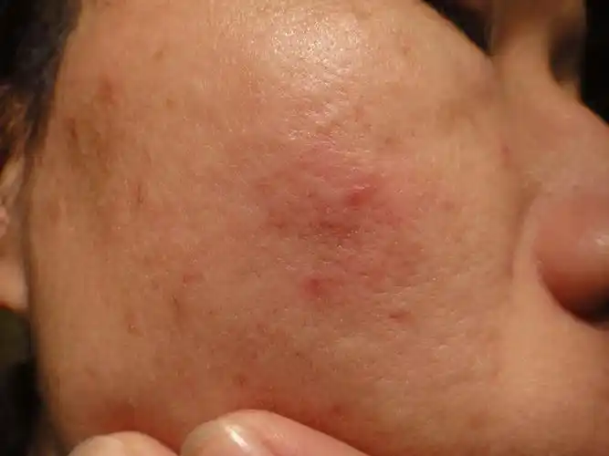 面部红疹,帮忙看看