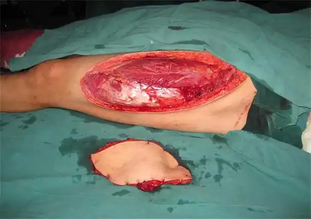 胫骨慢性骨髓炎皮瓣修复-遵义市播州区人民医院