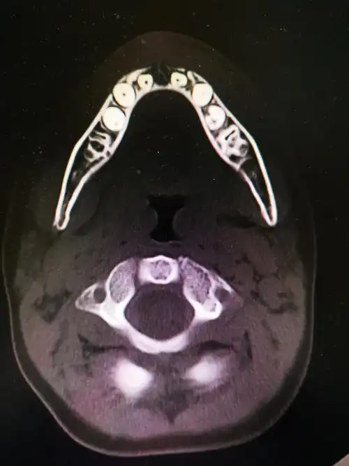 6岁男孩骑成人自行车上路摔伤致右下颌骨骨折,所以建议14周岁以下的