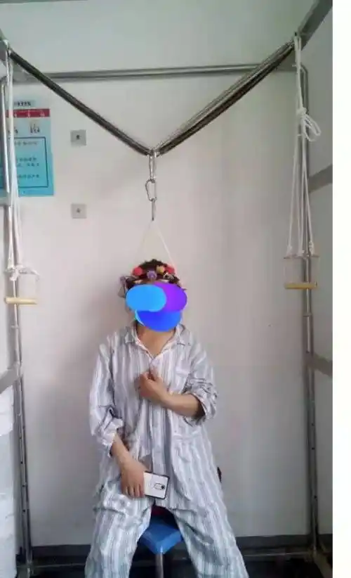 脊柱外科开展halo头颅环重力牵引治疗重度脊柱侧弯