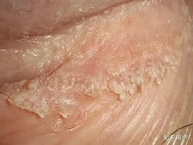 鸡儿长尖锐湿疣是怎样一种体验? - 知乎