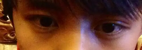 眼睛内陷,两眼对比右眼要内陷很多,原本双眼多是双