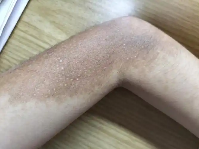 学会接受自己的不完美之色素沉淀