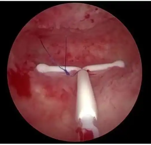 图为在宫腔内缝合固定好的曼月乐环