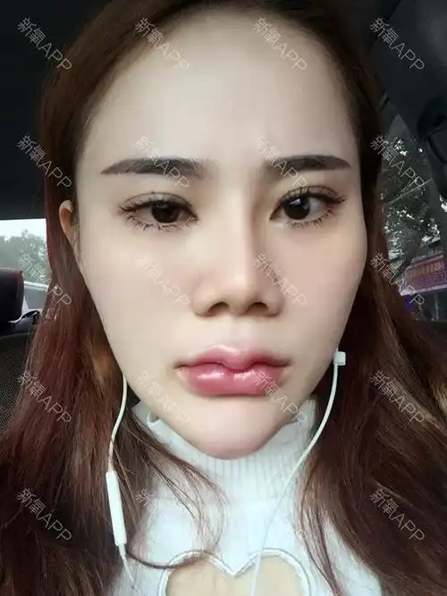 唇好不好_效果图_michelle_742152玻尿酸丰唇术后第0天_新氧美容整形