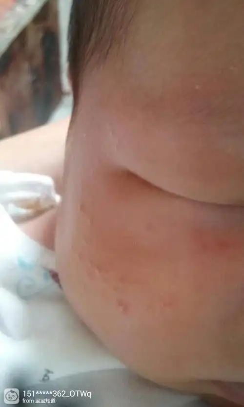 宝宝出生21天了,脸上长一粒粒还带点白色的东西,这是什么呀?
