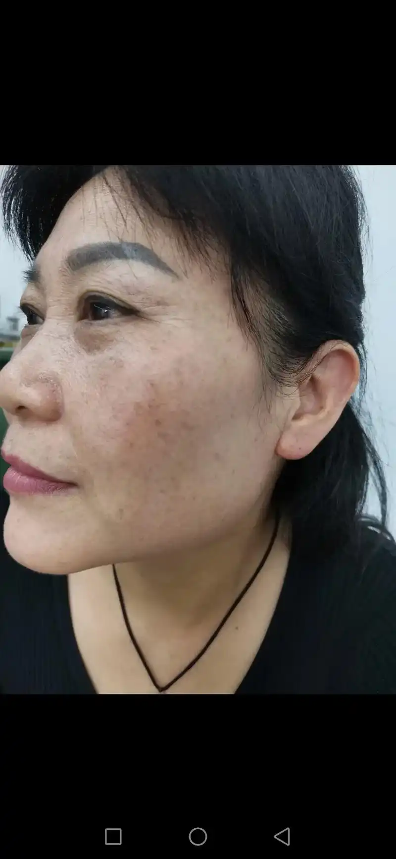 二十多年的真皮斑,一次技术后的效果 有问题皮肤的可以找我哦 - 抖音