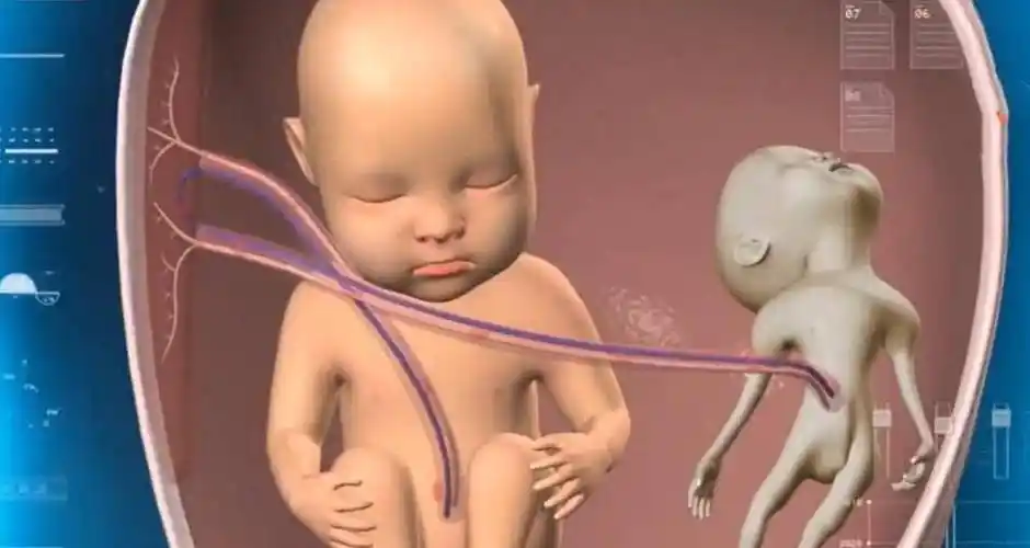 18年,女子怀孕5个月,为保胎医生直接在她肚子里给双胞胎做手术