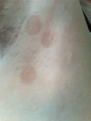 性别:女 年龄:20 大概半年前腋下长出了三个黄豆大小的浅褐色圆形色斑