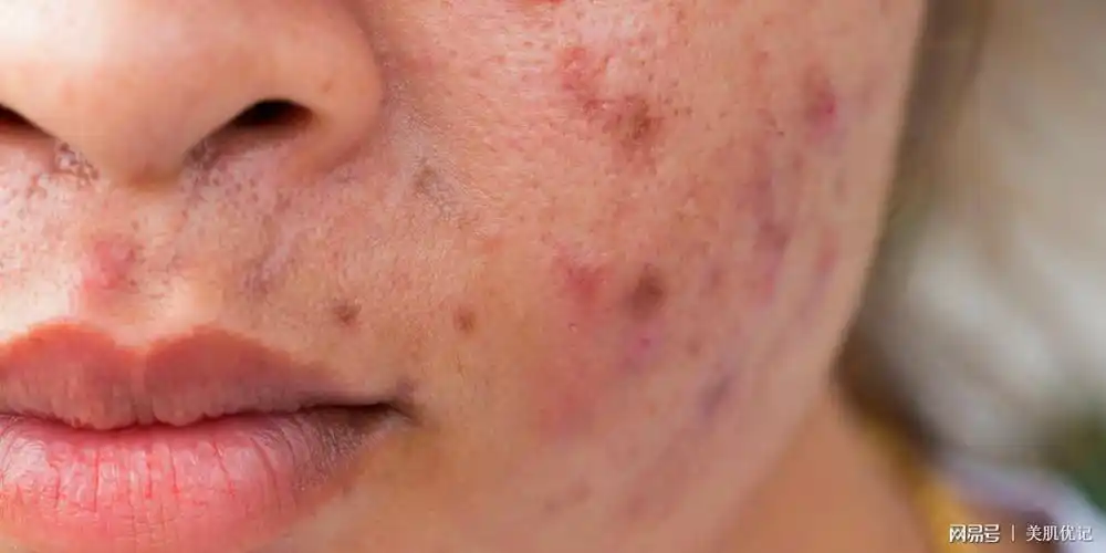 为肌解密‖基础护肤——青春期过了,为什么还长痘痘?