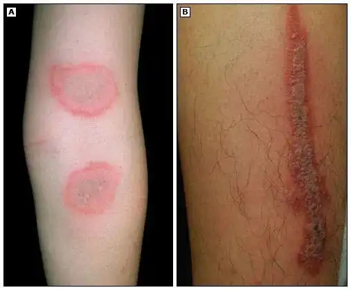带娃去户外当心 6 类毒虫,尤其第一种,严重可致命