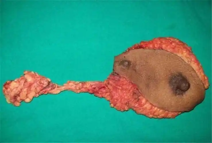 发生于副乳的乳腺癌图片